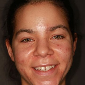female patient before cosmetic dental procedure